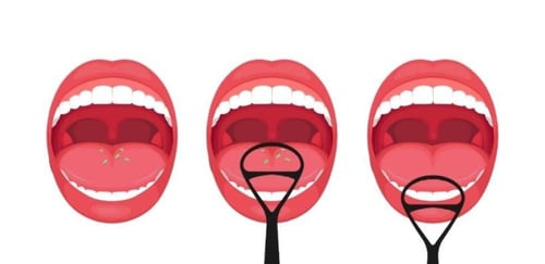 اورينكس منظف اللسان Orinex