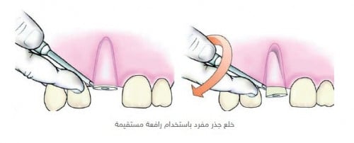 خلع السن الواحد (بقايا الجذور )