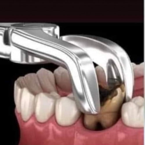 خلع ضرس العقل جراحي