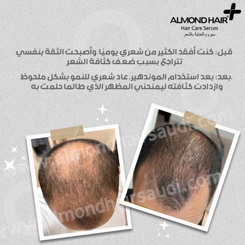 مجموعة مستلزمات نمو الشعر للرجال من الموندهير