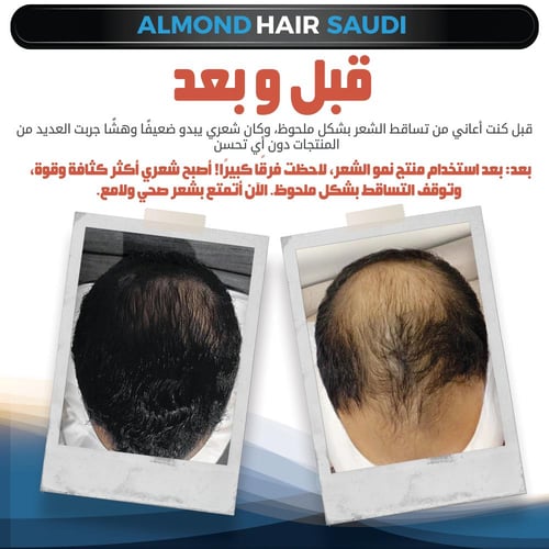 عبوتين سيروم الموند هير بلس القوة الفعالة للعناية...