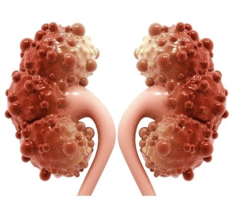 تنظيف الكلى