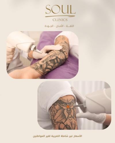 3جلسات ازالة تاتو صغير مع الأ خصائية