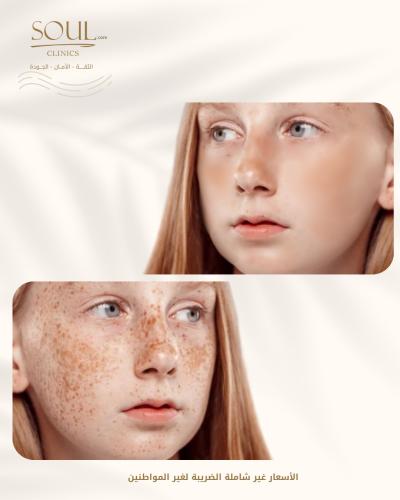 جلسة ازالة النمش بالليزر