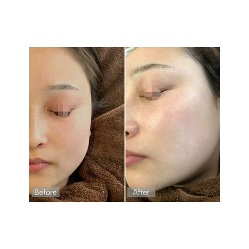 أمبولة هيالورونيك أسيد المركب 65%