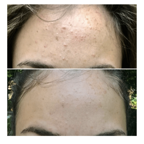 مسحات قطنيه لعلاج حب الشباب من ستريدكس - ٥٥ قطعة ق...