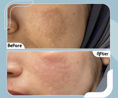 مجموعة تفتيح الوجه الأكثر مبيعاَ