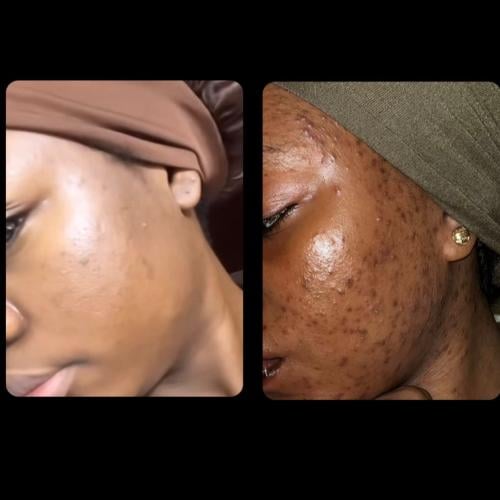 تونر التفتيح وعلاج الحبوب والمسام