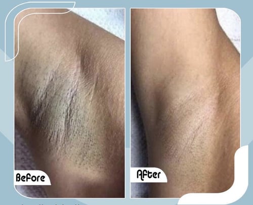 كريم تريبل أكت للبشرة الحساسة والمناطق الحساسة