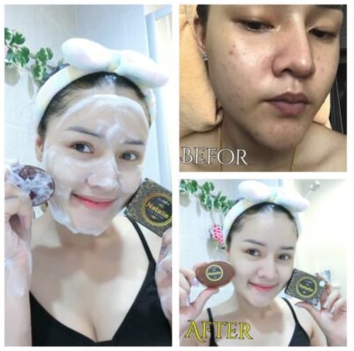 ناتالى صابون علاج لحب الشباب Natalie Soap
