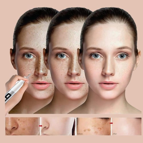 قلم الليزر الأصلي لإزالة الثؤلول والبقع السوداء وا...