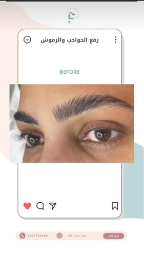 *رفع حواجب (eyebrow lift) - عدد محدود