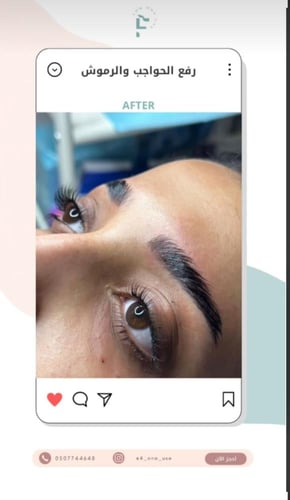 *رفع حواجب (eyebrow lift) - عدد محدود