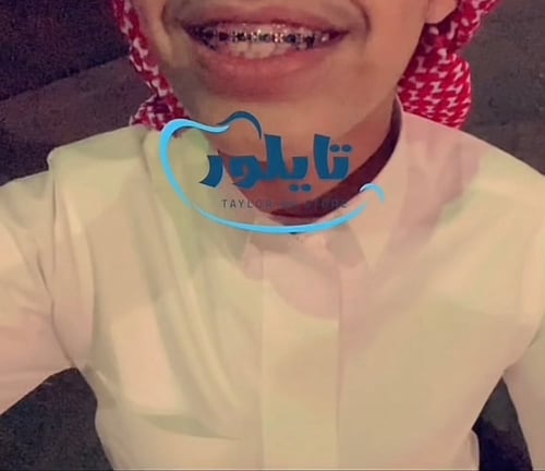 تقويم زينه منفصل تركيب غراء ثنين