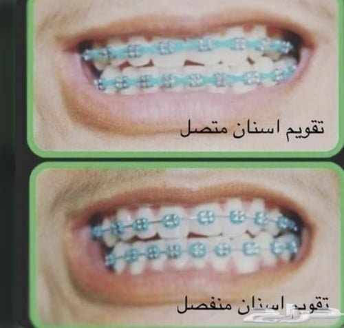 فكين تقويم زينه منفصل بدون غراء