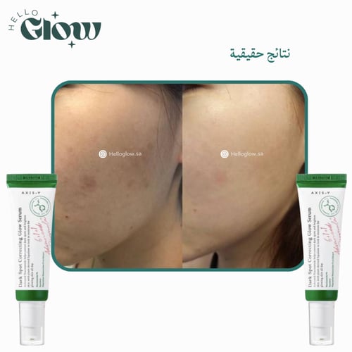 سيروم اكسس واي التوهج لتصحيح البقع الداكنة - AXIS-...