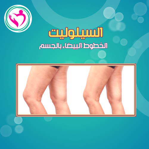 جلسة التخلص من السيلوليت وعلامات تمدد الجلد