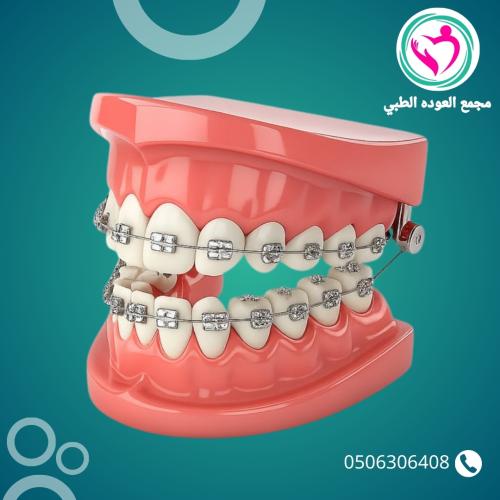 تركيب تقويم الاسنان للفك