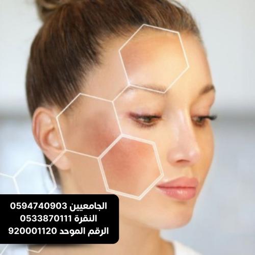 جلسة ازالة الوحمات التصبغية لمنطقة