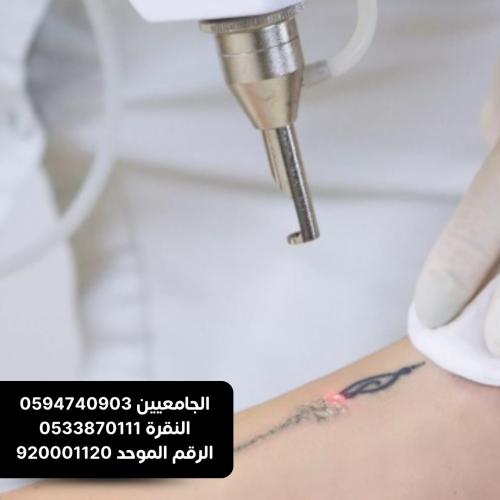 جلسة ازالة التاتو الصغير