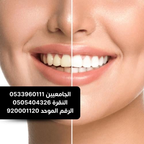 تلميع الاسنان