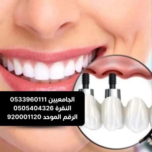 زرعة الاسنان ( بايو رايزون ) الامريكية بدون التركي...