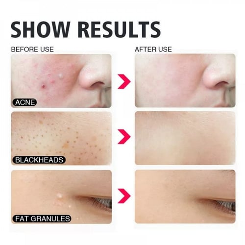 أداة إزالة البثور والرؤوس السوداء