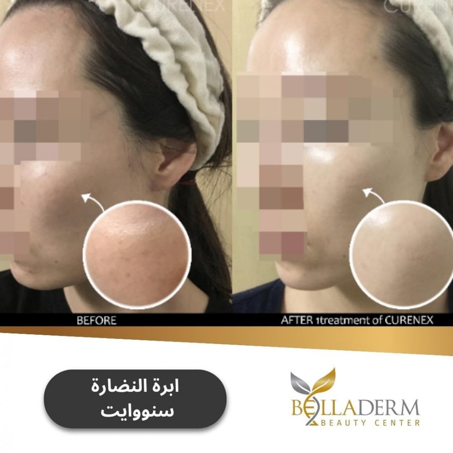 ابرة النضارة  سنووايت