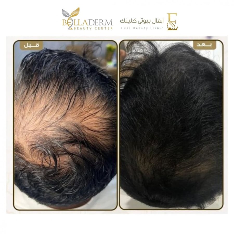 جلسة رجينييرا  بديل زراعة الشعر