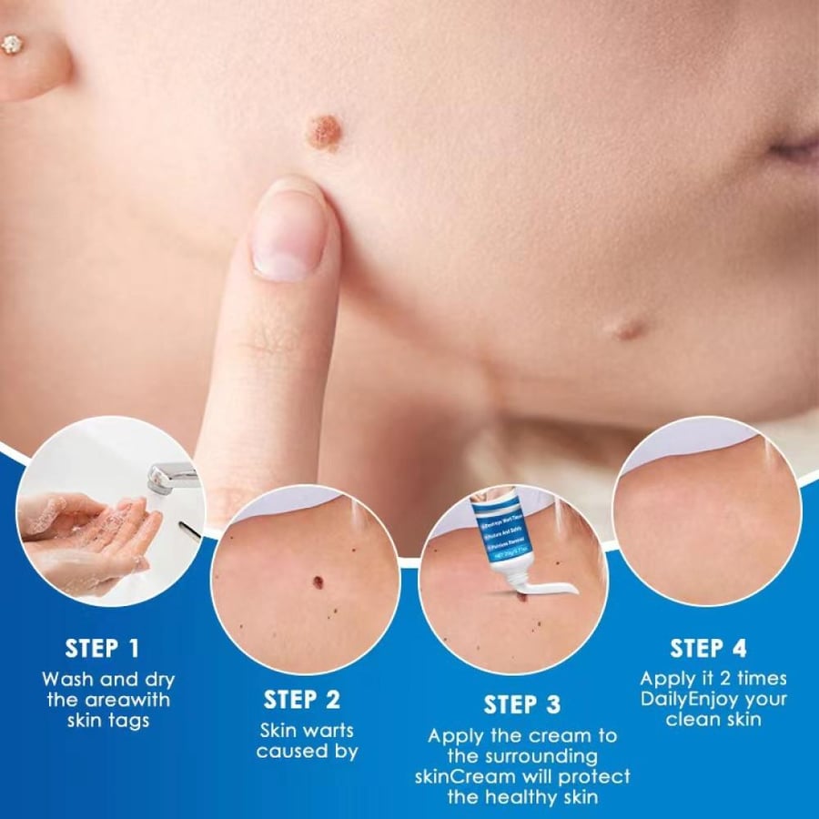 كريم HBESTY Wart Remover للعناية بالزوائد الجلدية 20 جم