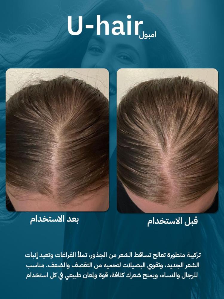 عبوتين يو هير امبول U Hair Ampoule | أفضل علاج لتساقط الشعر وتكثيف الشعر من الجذور