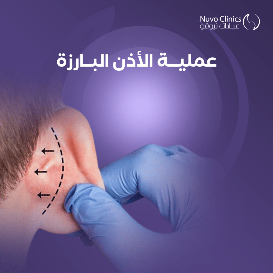عملية الأذن البارزة