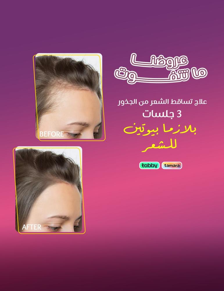 بلازما بيوتين لكثافة الشعر - عيادات برنسيس