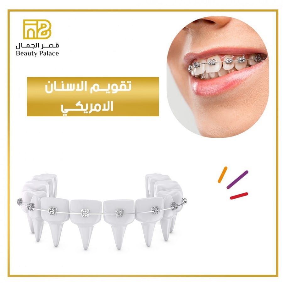 تقويم اسنان فكين