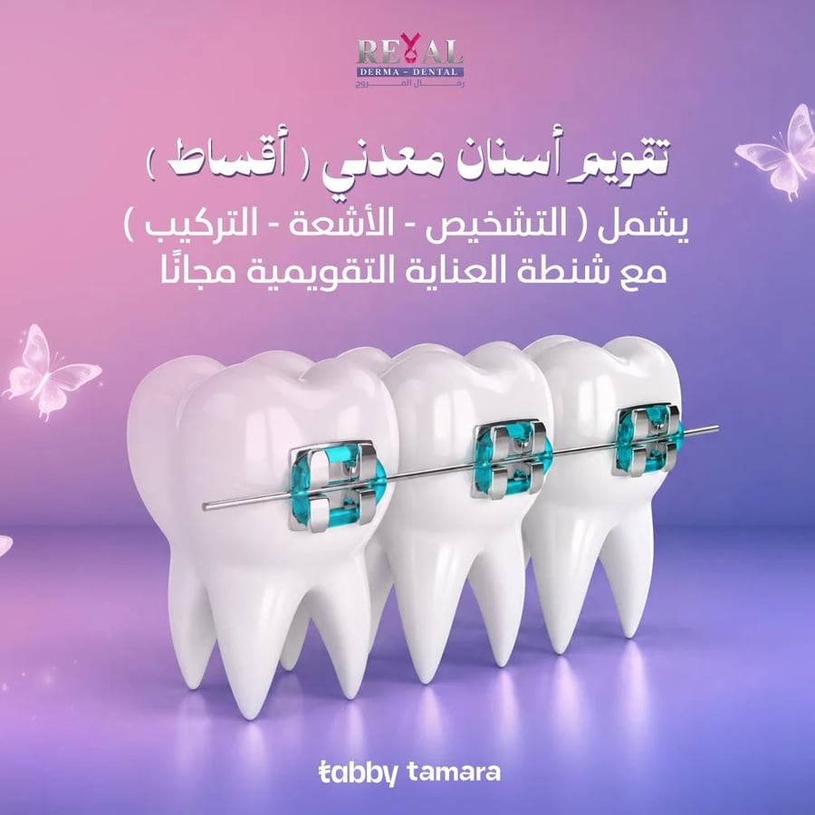 تقويم الاسنان المعدني بالتقسيط