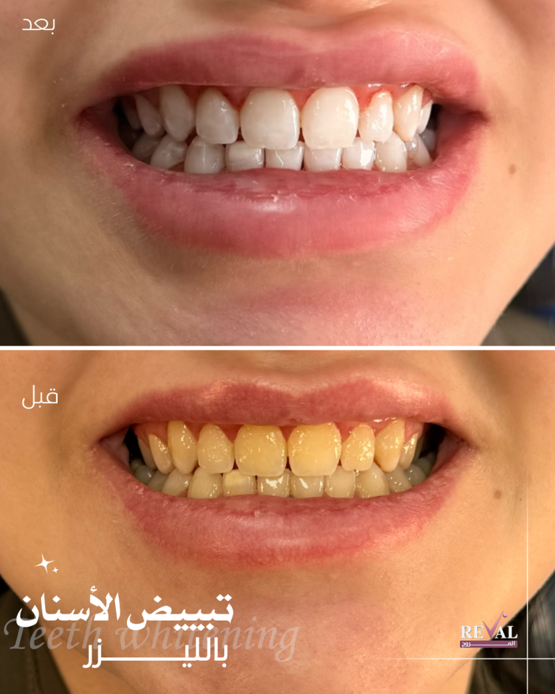 نتيجة تنظيف وتبييض الأسنان بالليزر لإزالة الاصفرار والتصبغات