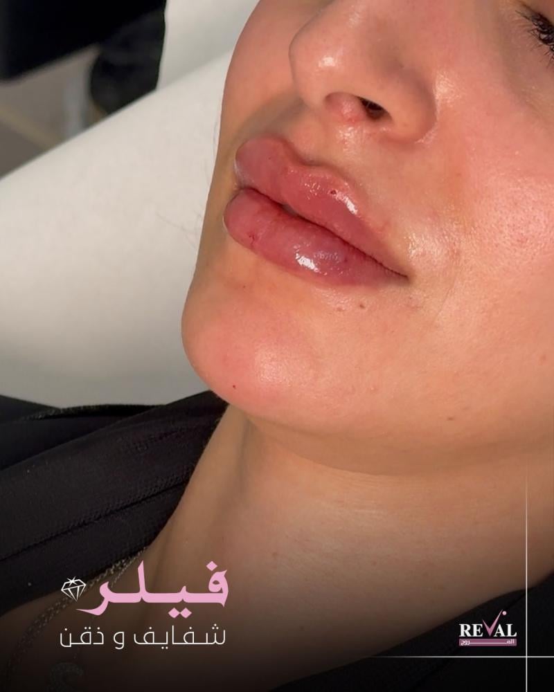 فيلر 1 مل للأنواع (اوبرا، بوش، ايلين)
