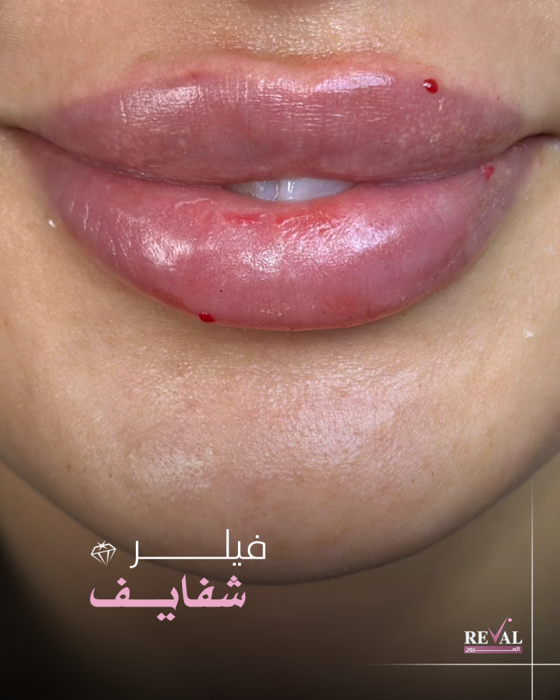 فيلر 1 مل للأنواع (اوبرا، بوش، ايلين)