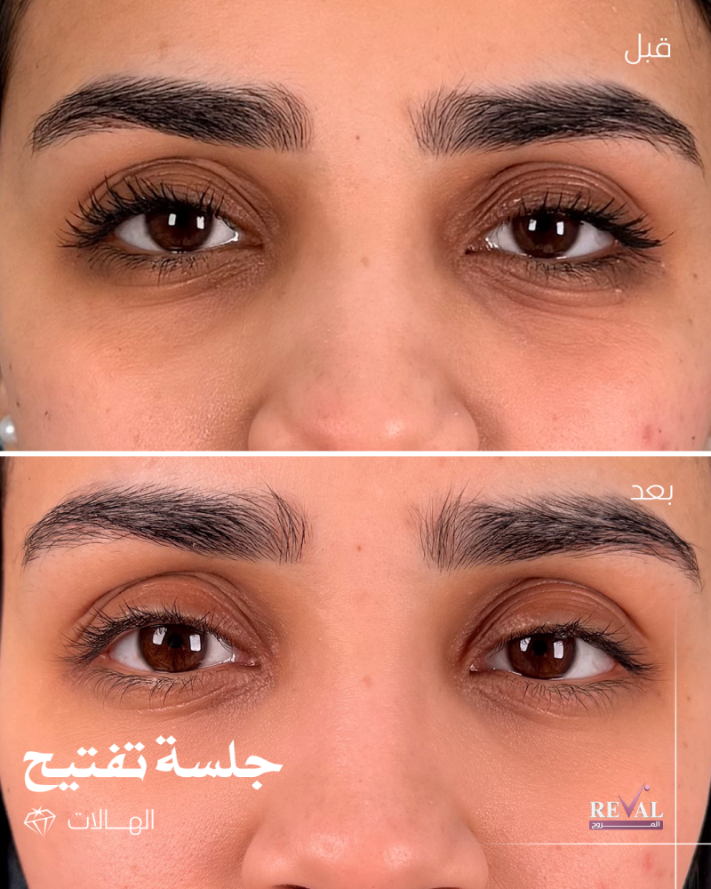 3 جلسات انوفيال + الكريم المنزلى