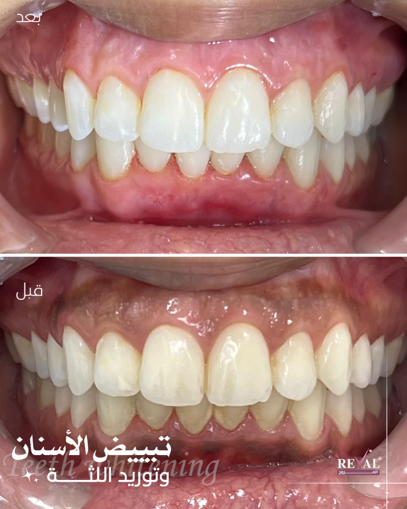 قبل وبعد توريد اللثة مع تنظيف وتبييض الأسنان في رفال المروج بالرياض