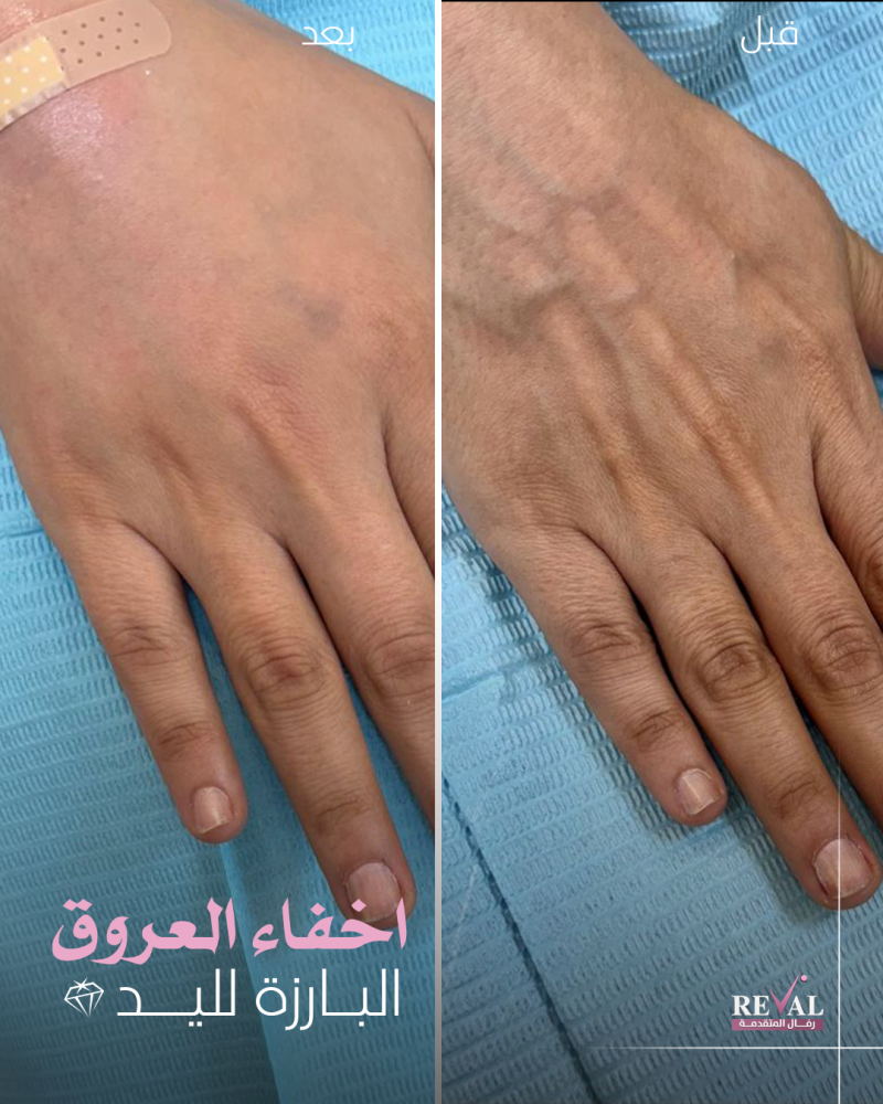 فيلر الكالسيوم 1.5 مل فيستم