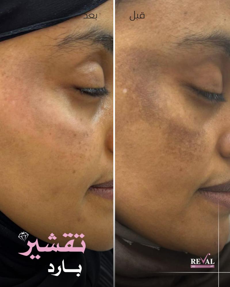 تقشير كيميائي الامريكي لمنطقه واحدة