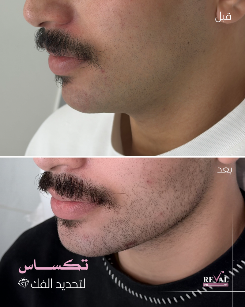 3مل فيلر + 1مل أو بوتكس مجاناً( اوبرا - ايلين - بوش )