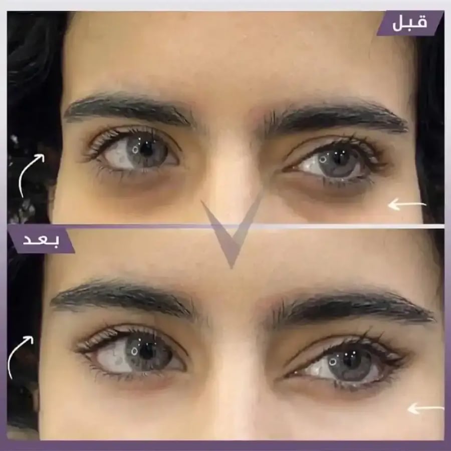 ابرة الانوفيال 3مل ( للنضاره التفتيح وتخفيف الخطوط )