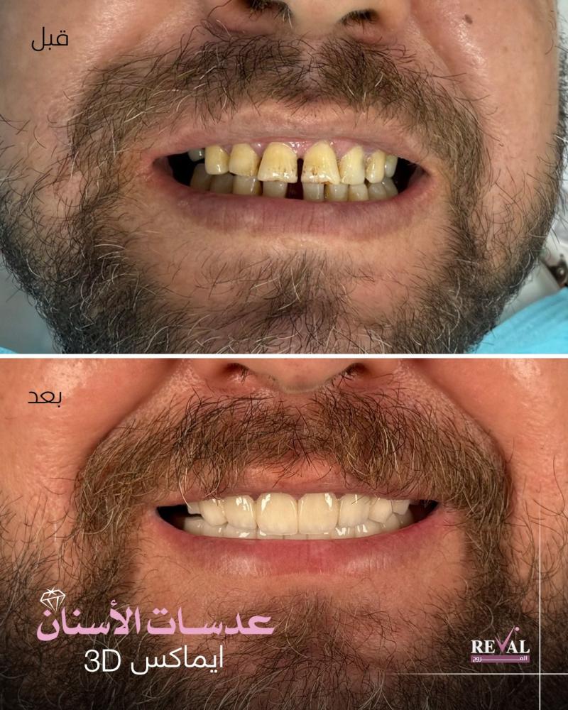 قبل وبعد تركيب ابتسامة هوليود