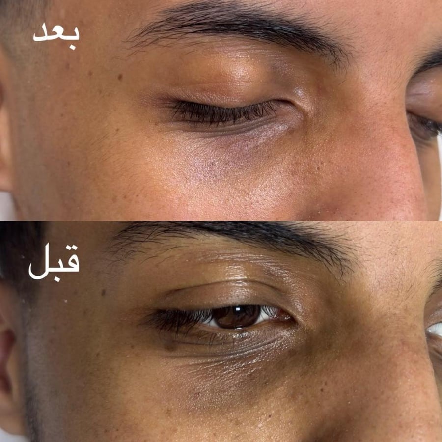 ابرة الانوفيال 3مل ( للنضاره التفتيح وتخفيف الخطوط )