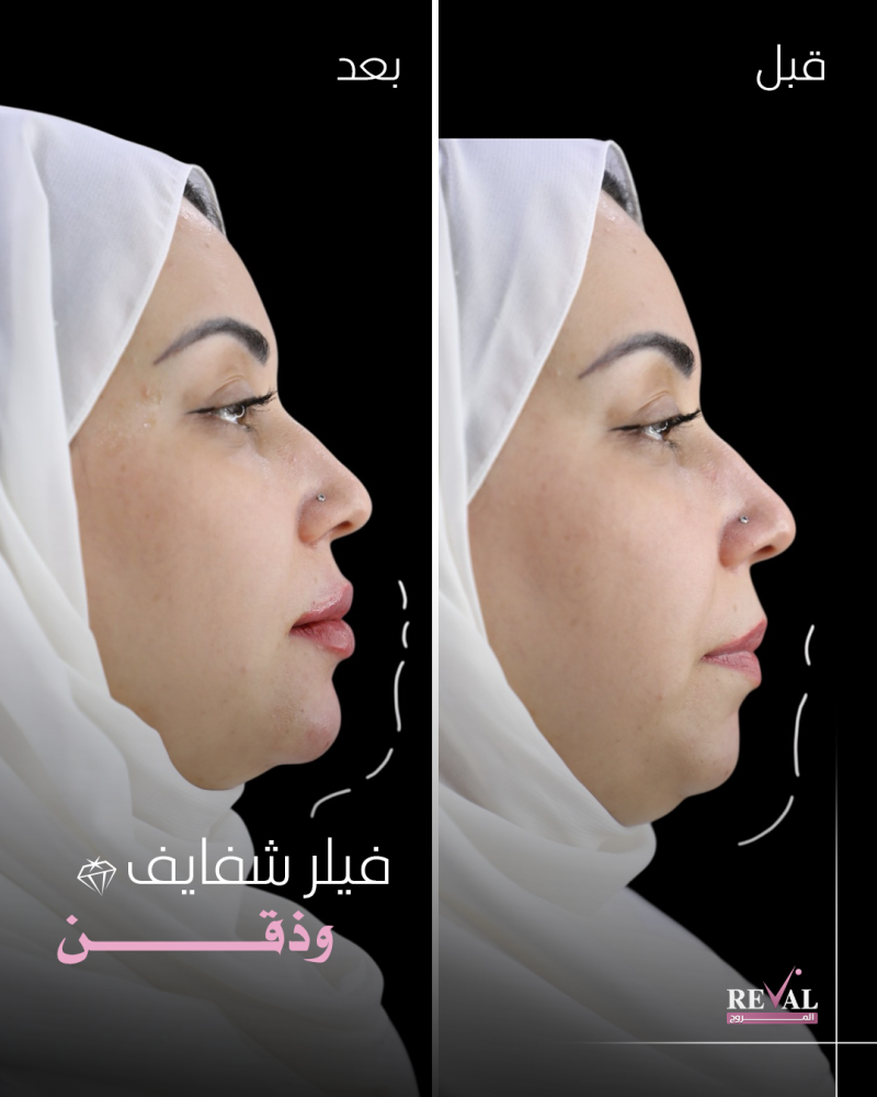 3مل فيلر + 1مل أو بوتكس مجاناً( اوبرا - ايلين - بوش )