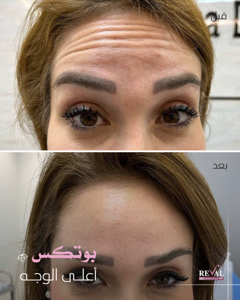 شكل الجبهة بعد جلسة حقن البوتكس مع إبرة الراديس في رفال المروج