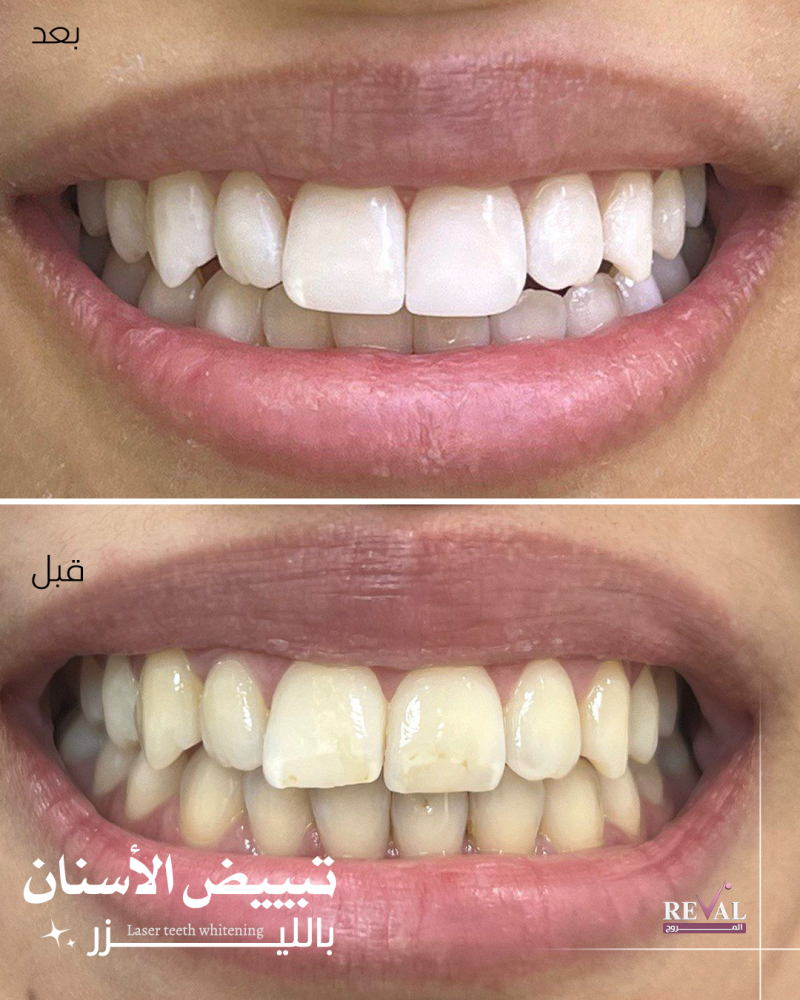 تنظيف وتبييض الأسنان عدة درجات في جلسة واحدة قبل وبعد الإجراء التجميلي