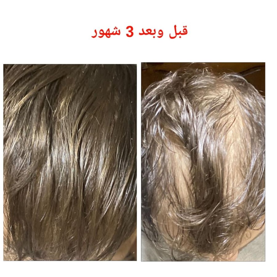 زيت شعر